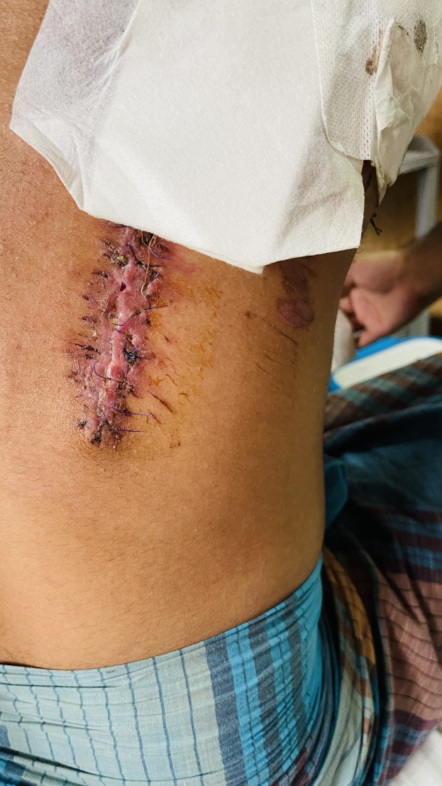 Ein Mann in einem Krankenhausbett mit einem Verband am Bein und einer Narbe am Bauch, mit einer anderen Person und einem Tisch im Hintergrund.