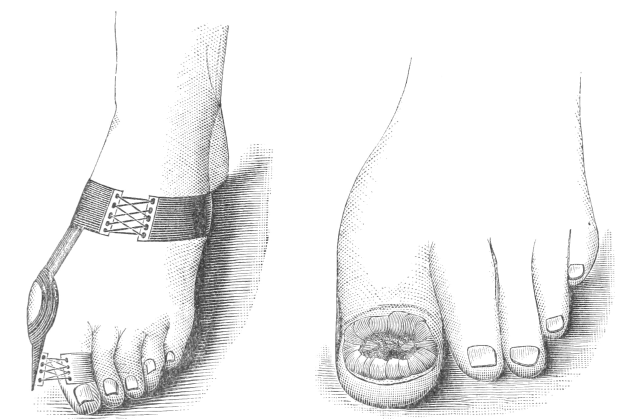 Schwarzer und weißer Abdruck von zwei Füßen, einer mit einem Verband und der andere mit einer sichtbaren Fraktur, mit Text, der die Behandlung angibt.